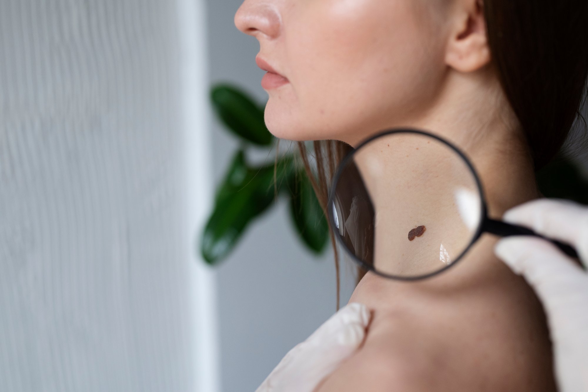 female-doctor-diagnosing-melanoma-body-female-patient female-doctor-diagnosing-melanoma-body-female-patient